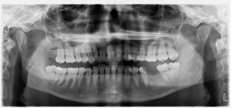 Dental panoramic X-ray of the teeth showing the structure of the teeth, with the lower molar missing