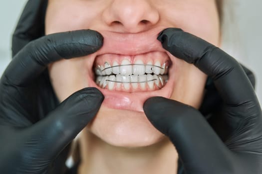 Close-up of open mouth with teeth with metal orthodontic plate, hands of orthodontist doctor in black medical gloves showing her teeth. Treatment, dental care, orthodontics, dentistry, health concept