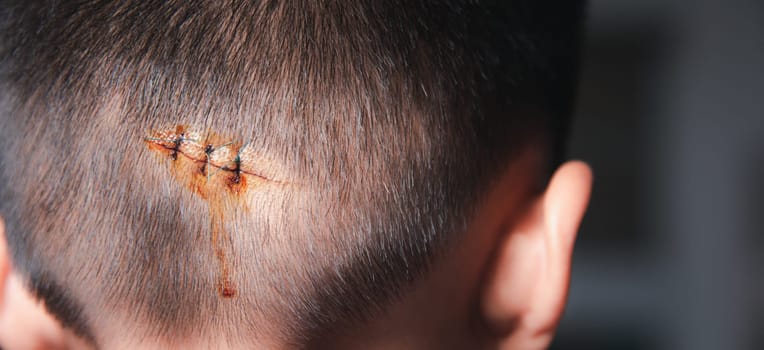 The lacerated sutured wound of kid back head which suture by nylon suture about 3 stitches at the emergency room of the hospital, Medical care of the surgery lesion on the head, children of Accident