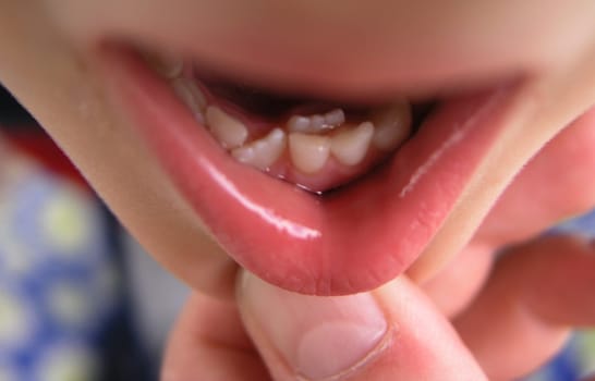 When the second molars come,the teeth are straightened.