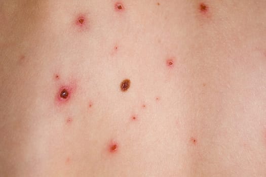 Chickenpox (subsiding)