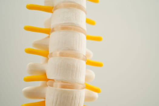 Spinal nerve and bone, Lumbar spine displaced herniated disc fragment, Model for treatment medical in the orthopedic department.