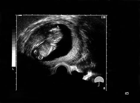 Ultrasound