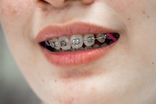 Braces in teenage girl mouth to treat and beauty for increase confidence and good personality.