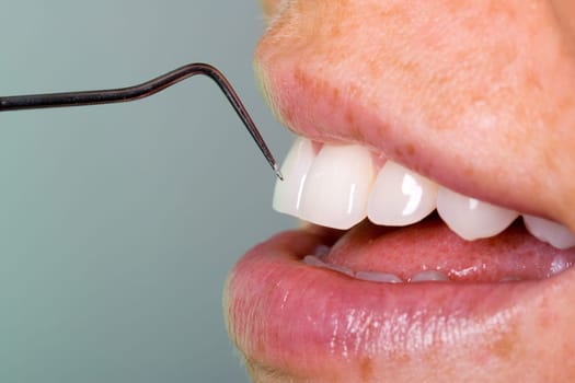 Dental check-up with probe