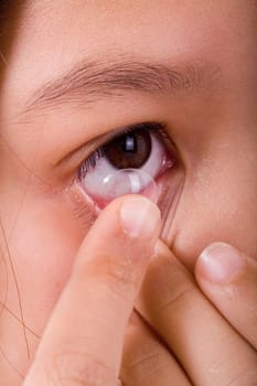 Insertion of the contact lens