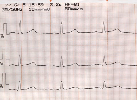 ELECTROCARDIOGRAM