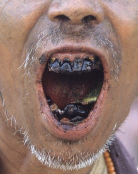 an encounter on one of my travels in Nagaland,the land of the former headhunters in the far northeast of India. The headhunters turn their teeth black with the background that they say only dogs have wise teeth.