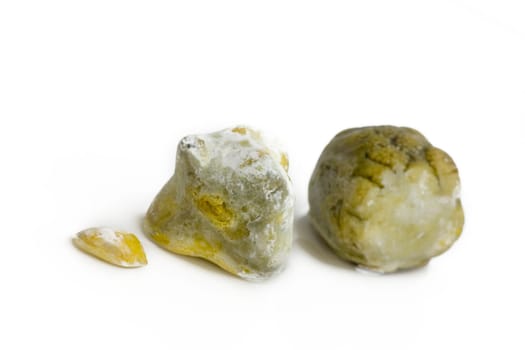 Gall stones