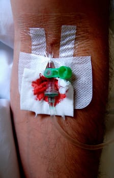 Venous access