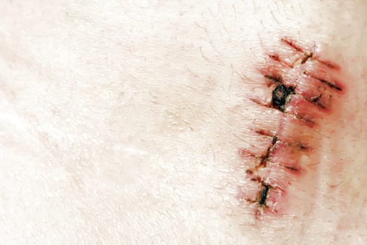 detail of scar