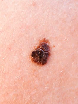 Age wart