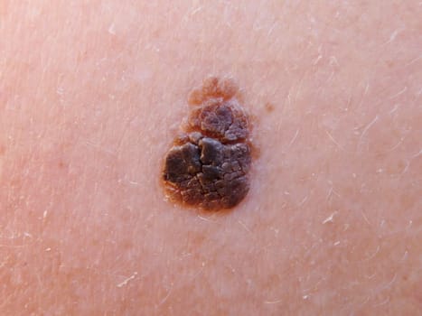 Age wart