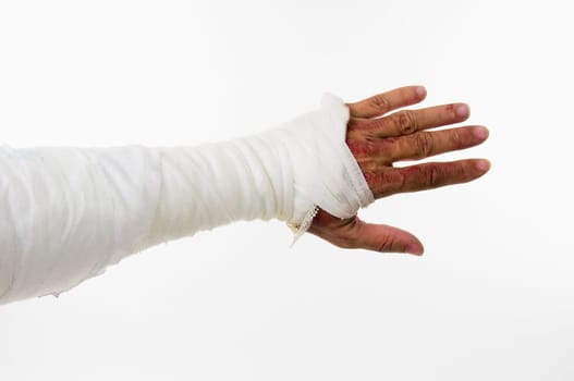 Bandaged arm with burns