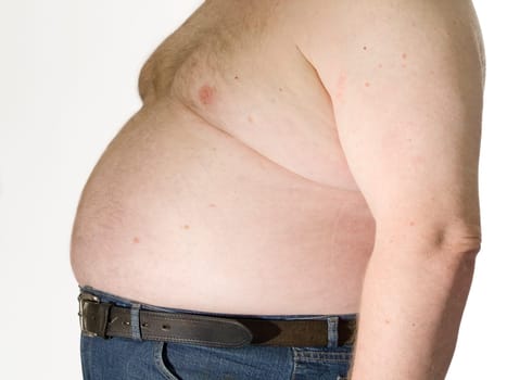 Obesity