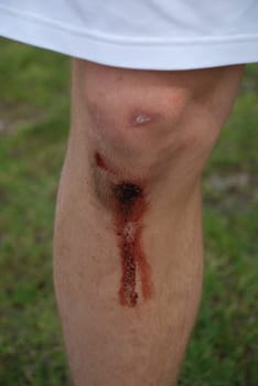 Sports accident wound knee