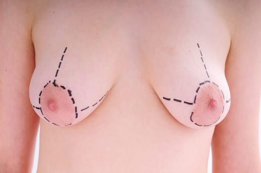 female breast before plastic surgery