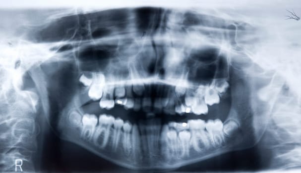 Panoramic dental tooth x-ray - new teeth growing