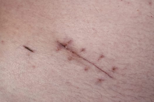 Scar - Surgery