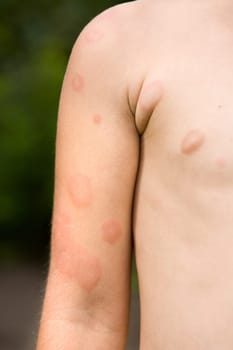 Rubella