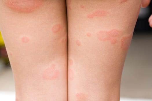 Rubella