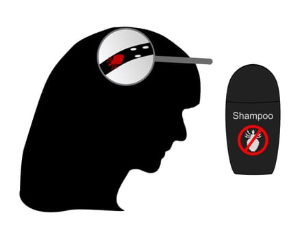 Woman's head,louse,nits and lice shampoo
