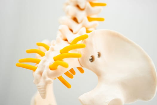 Lumbar spine displaced herniated disc fragment, spinal nerve and bone. Model for treatment medical in the orthopedic department.