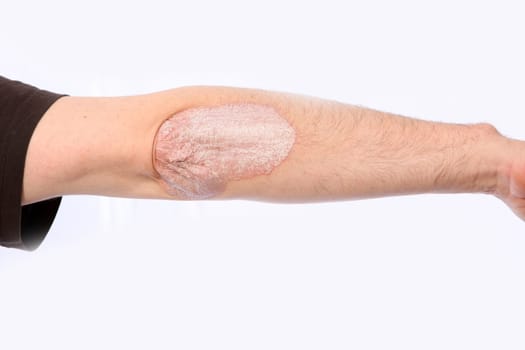 Psoriasis on the leg