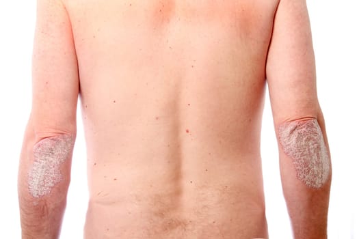 pronounced Psoriasis on both elbows