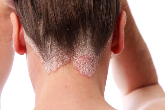 pronounced Psoriasis on both elbows