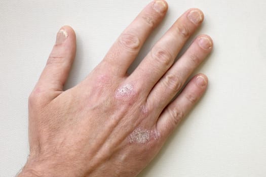 Psoriasis - Psoriasis on the hands and fingernails