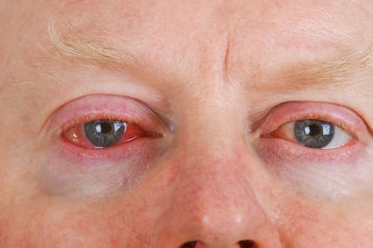 Conjunctivitis