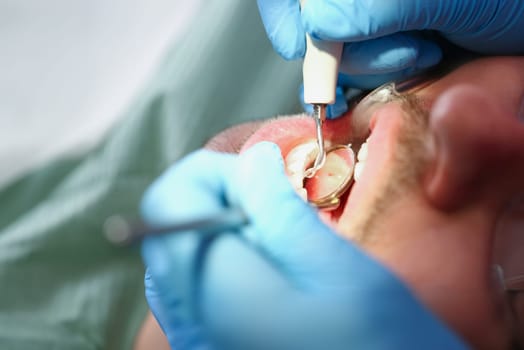 Close-up of person on appointment in stomatology clinic, getting tooth fixed, reduce pain. Dentist provide teeth care. Health, stomatology, help concept