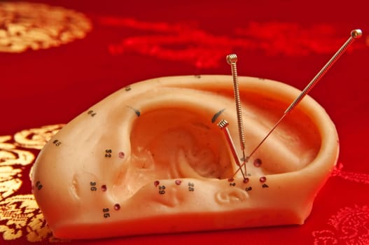 Ear Acupuncture