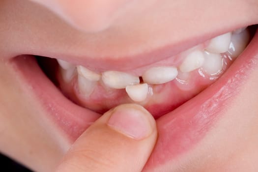 Dentition of a five-year-old girl with a wobbly tooth (mr)