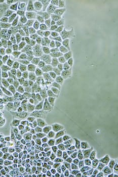 Microscope view of womens health Ductal Breast Cancer cells in tissue culture showing walls, nucleus and organelles.