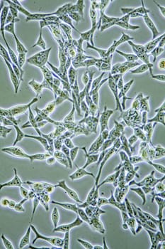 Microscope view of mens health Prostate Cancer cells in tissue culture showing walls, nucleus and organelles.