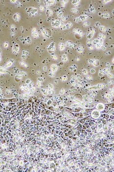 Microscope view of Colon Cancer cells in tissue culture showing walls, nucleus and organelles.