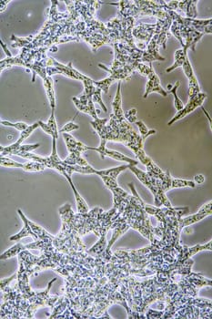 Microscope view of mens health Prostate Cancer cells in tissue culture showing walls, nucleus and organelles.