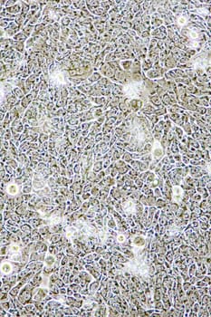 Microscope view of Colon Cancer cells in tissue culture showing walls, nucleus and organelles.