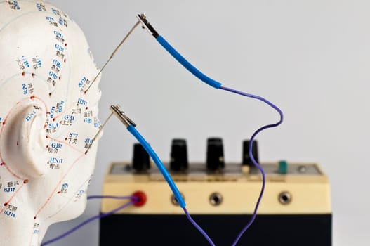 Electro-Acupuncture