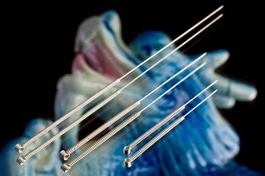 Acupuncture needles
