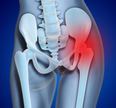 An illustration of a foot xray with a red spot showing the injured ankle.