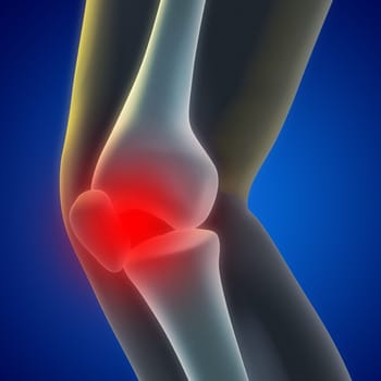 An illustration of a knee xray showing the injury.
