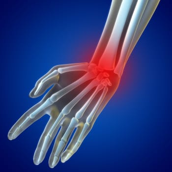 An illustration of a wrist xray showing the injury highlighted in red.