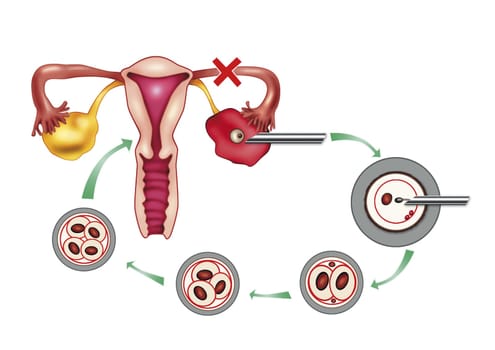 diagram illustration of artificial insemination process