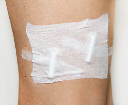 Sclerotherapy