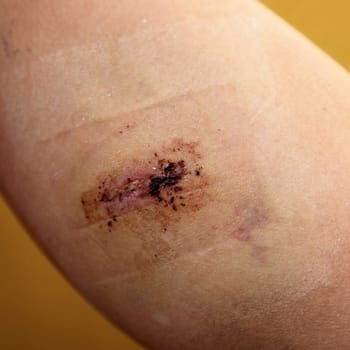 Close-up - injury with stitched wound - square