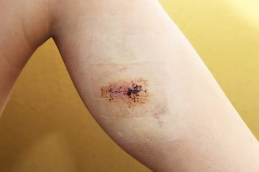 injury on the leg - close-up of the wound with stitches
