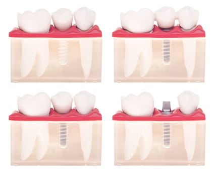 dental model with different types of treatments (implant placement, bonded bridge, crown over implant) isolated on white background